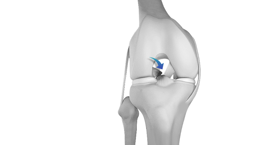 ACL Reconstruction