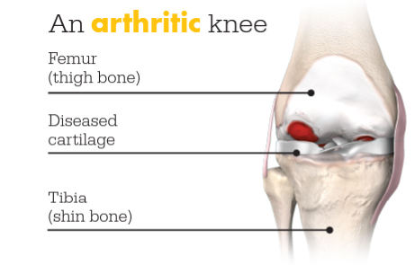 Total Knee Replacement