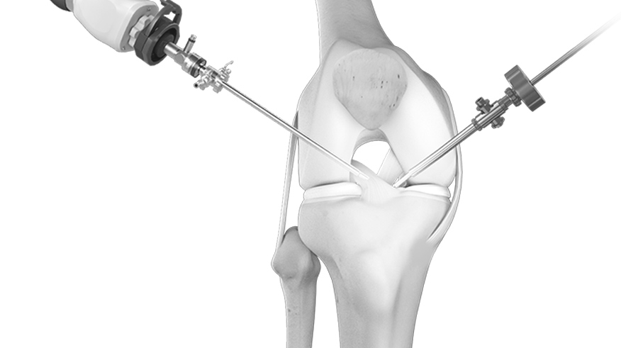 Arthroscopic Knee Surgery