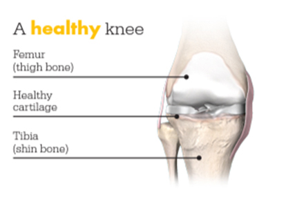 Mako Smart Robotics for Total Knee Replacement