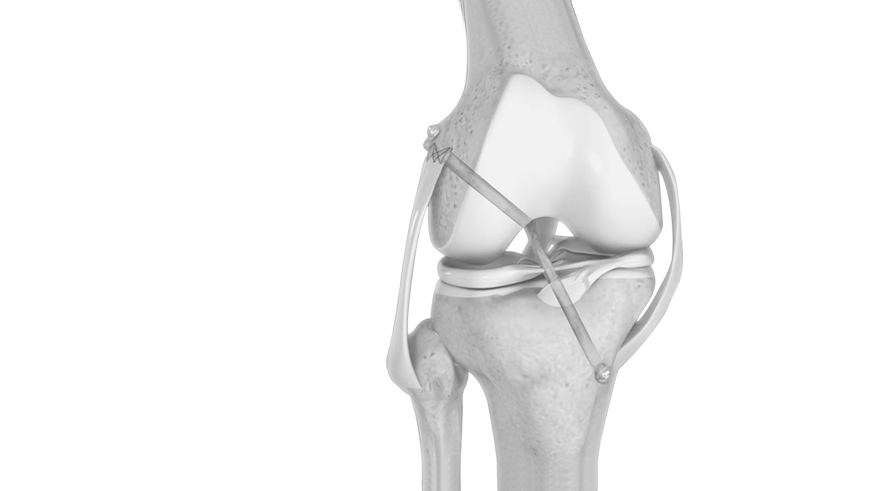 Knee Ligament Reconstruction