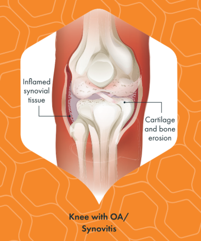 Arthrosamid® Injections