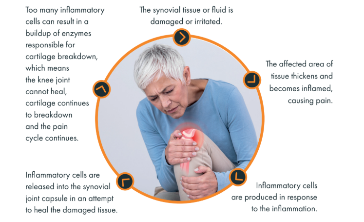 Arthrosamid® Injections
