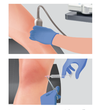 Arthrosamid® Injections